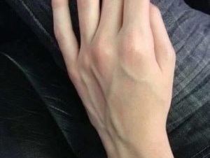 traitement des varices sur les mains à la maison